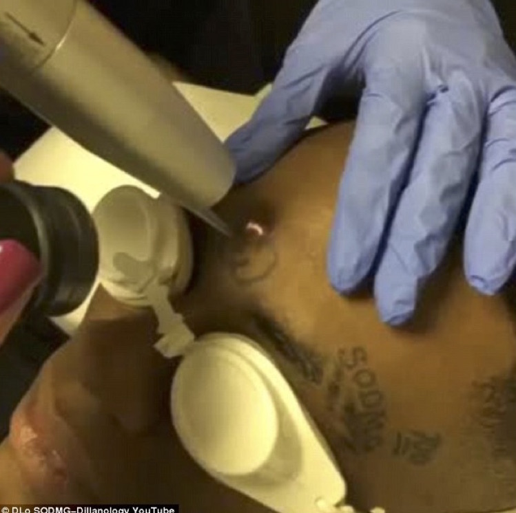 Soulja Boy Gets Tats Removed From Face