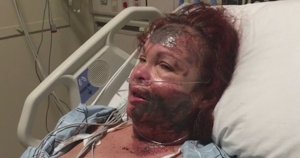 N.Y. Woman Sprays Acid In Her Own Face And Blames Imaginary Black Woman