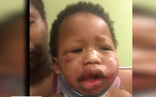 Baby Is Badly Beaten At Daycare Center